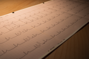 A sheet of paper showing ECG