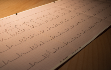 A sheet of paper showing ECG